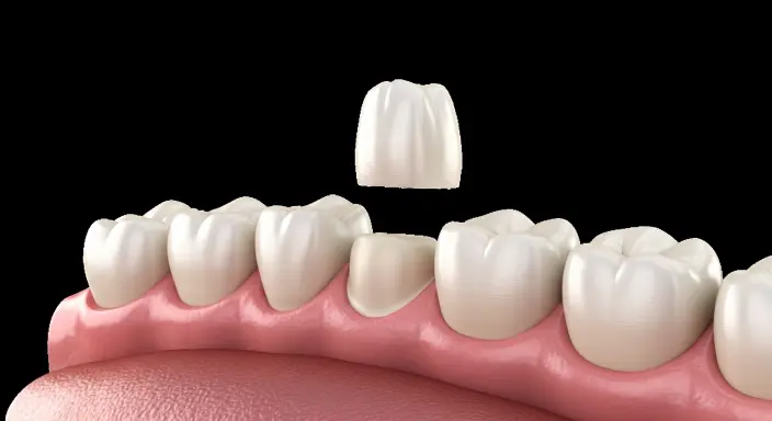 Dental Crown Coating Application